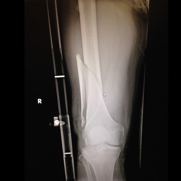 Slishman Traction Splint (STS) - Image 5